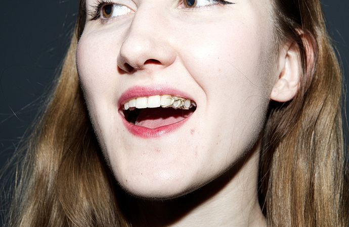 Tereza Rezáčová - dentální šperk zlato