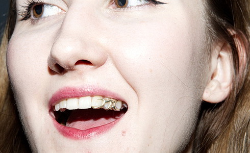 Tereza Rezáčová - dentální šperk zlato